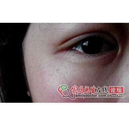 做了E光美容,脸上红血丝不见了